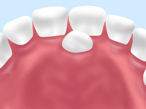 過剰歯の抜歯もおまかせください～3DCTを用いた安全かつ精度の高い治療～